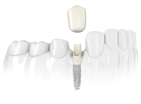 Nobel Biocare Dental Implants