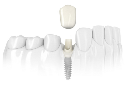 Dental implant model from McNickle Family Dentistry 