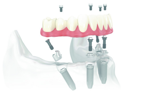 Dental implant diagram