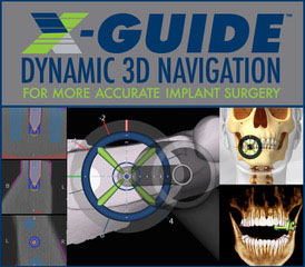 X-guide diagram from McNickle Family Dentistry