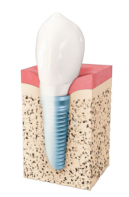 Model of Nobel Biocare dental implant from McNickle Family Dentistry  